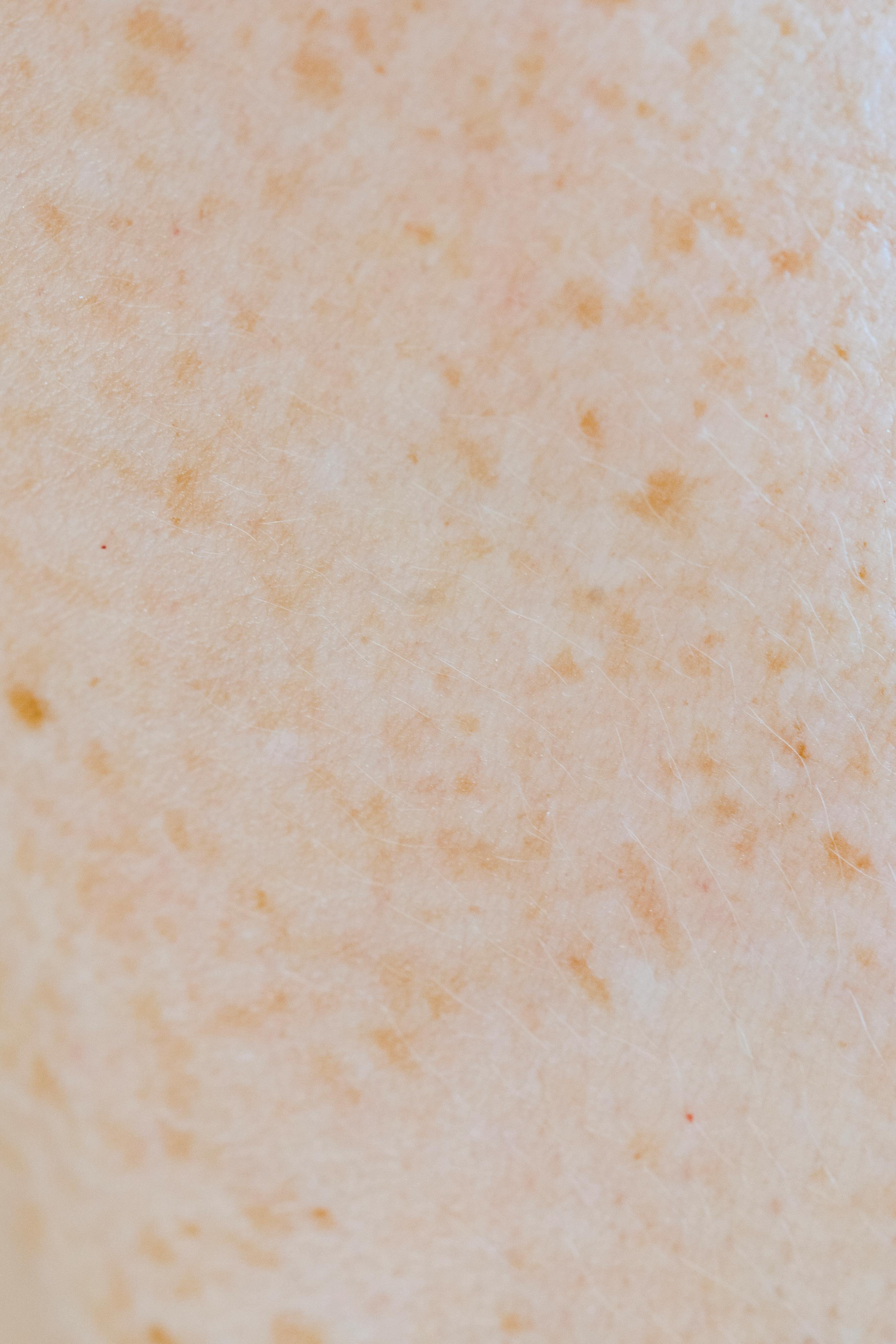 best serum for hyperpigmentation