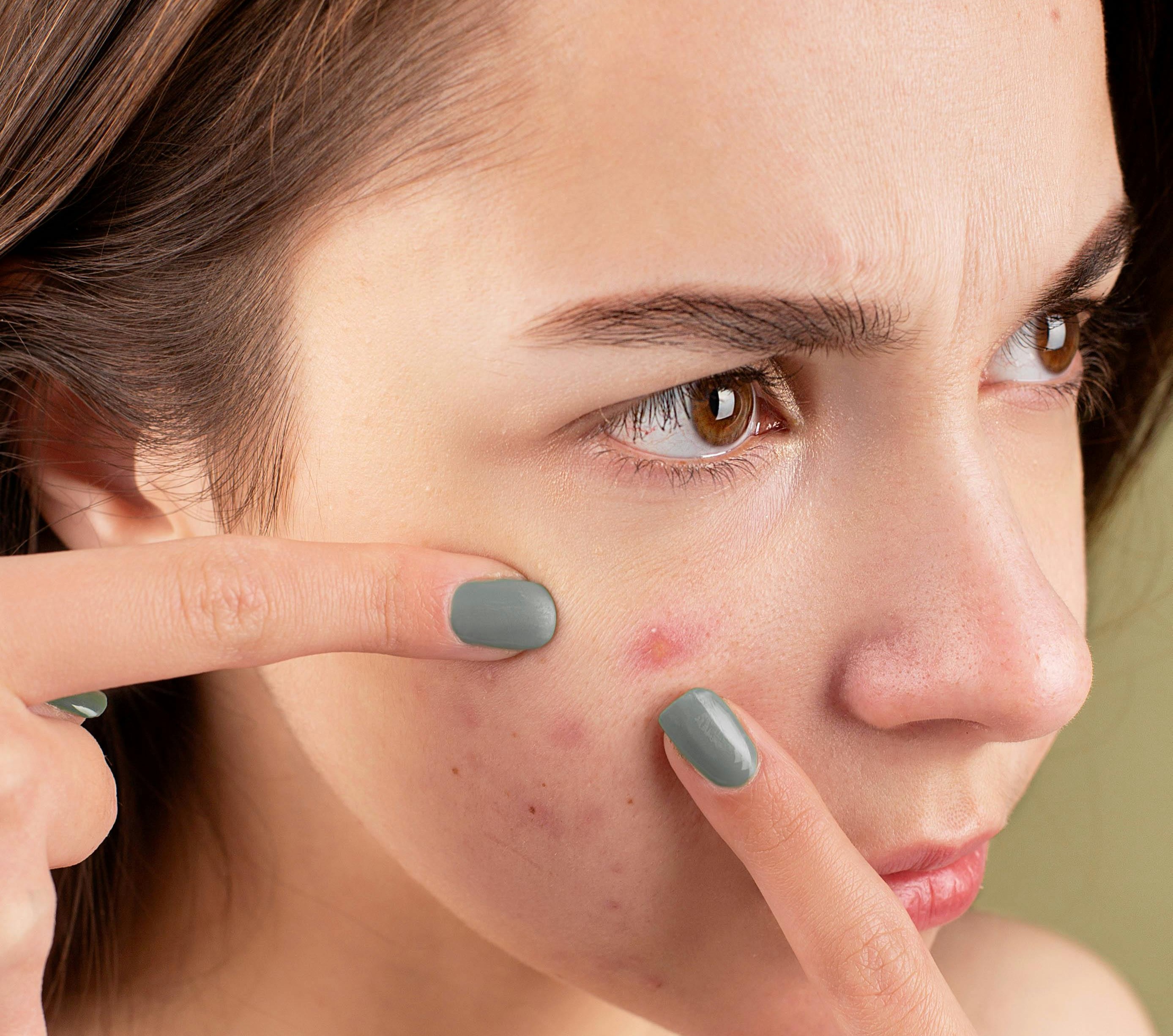 how to remove acne scars